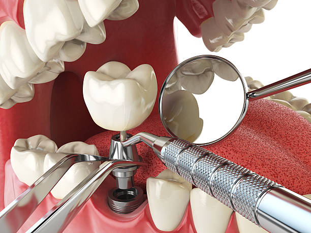 Best Emergency Dental Care for Abscessed Tooth in Los Molinos, CA